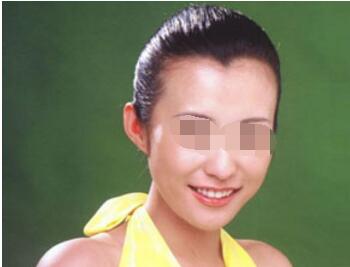 上海名仁整形医院美人尖种植的优点  头发种植后还会掉吗
