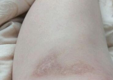 还在为疤痕困扰吗  天津河东菲丝澜整形医院激光祛疤优点