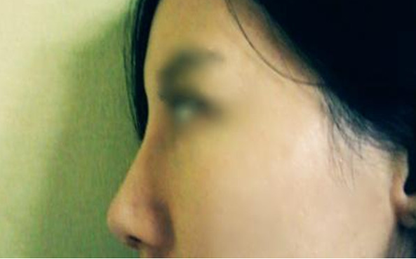 重庆爱思特医院做耳软骨<font color=red>垫鼻尖手术</font>时间是多久