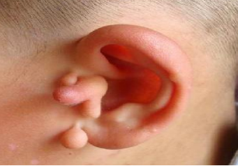 南京欧华国际整形医院副耳切除术的优势  让你耳部无瑕疵