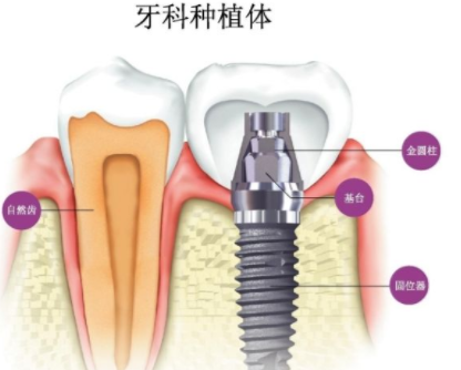 大连沙医生口腔专科整形医院种植牙修复牙齿效果怎样 