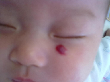 杭州婉美整形医院祛胎记价格多少 激光去胎记可靠吗