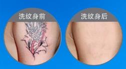 郑州第五人民医院激光<font color=red>洗纹身</font>多少钱  都注意些什么呢