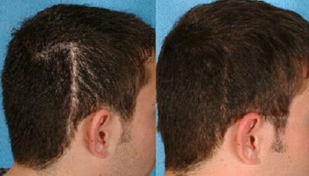 福州曙光植发整形医院疤痕头发种植效果怎样 有后遗症吗