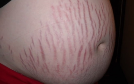 如何消除妊娠纹的方法 赣州明珠丽格整形激光祛妊娠纹价格