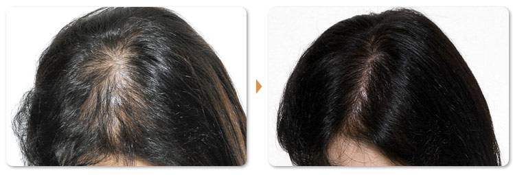 天津友好医院头发种植过程 你也可以拥有健康秀发