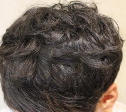 头发掉如何治疗 广州科发源种植头发多久见效