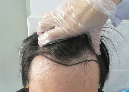 广州新生植发医院发际线种植效果 一定会让你心动