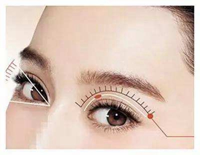 齐齐哈尔医学院整形科韩式埋线双眼皮效果 给你靓丽双眼