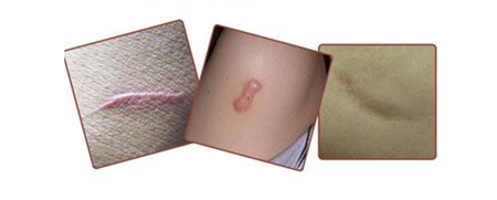 疤痕怎么去 郴州中医院激光祛疤 简单修复疤痕的方法