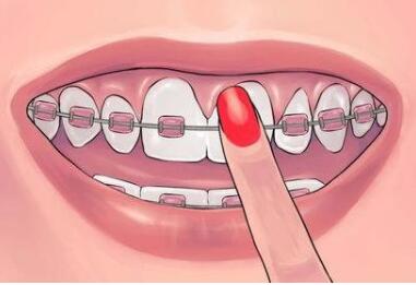 牙齿矫正怎么做  上海圣贝口腔整形医院<font color=red>牙齿矫正有哪些好处</font>