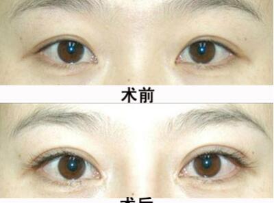广州植发医院排名  广州科发源植发医院睫毛种植的优点