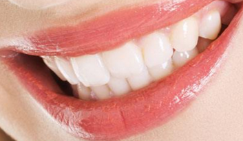 牙齿矫正有哪些误区 <font color=red>上海美维口腔门诊部</font>牙齿的矫正方法