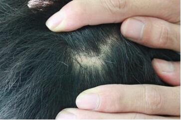 宁波植发哪里好 宁波美莱植发医院疤痕植发有哪些优点