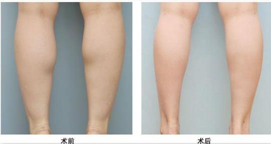 北京米扬整形医院腿部吸脂的优点 让您尽显青春活力