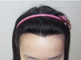 广州移植头发哪里好 美人尖种植后多久见效
