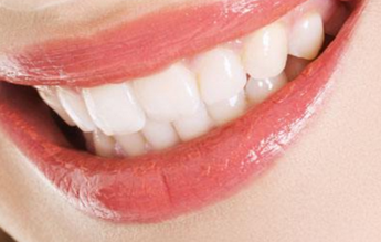 【牙齿整形】牙齿修复/种植牙 给你一个整齐牙齿