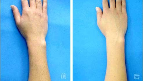 广州军区总医院激光整形中心激光手臂脱毛效果如何 多少钱