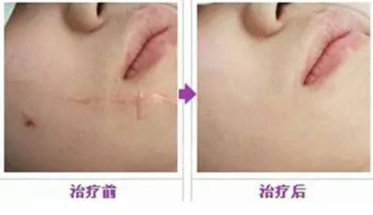 广州博仕整形医院激光祛面部疤痕效果怎样 几次见效