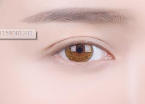 双眼皮术后会有疤痕的原因 成都派瑞思医院双眼皮手术优势 