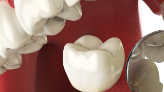 武汉大众口腔门诊部牙齿修复效果好吗 牙齿修复的优点
