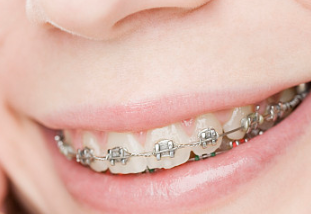 长沙美奥口腔医院牙齿矫正年龄有限制吗 塑造自信微笑