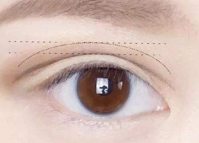 四川省医学科学院整形科做埋线法双眼皮手术需要多少钱