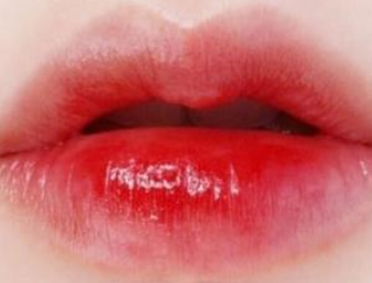 上海宏康医院整形科<font color=red>厚唇改薄术会留疤痕吗</font> 让香肠嘴变薄