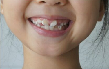 武汉牙齿矫正的方法有哪些 整齐的牙齿能很好提升形象