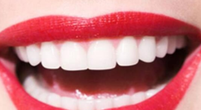 北京做<font color=red>烤瓷</font>牙价格是多少 整洁的牙齿让您的笑容更自信