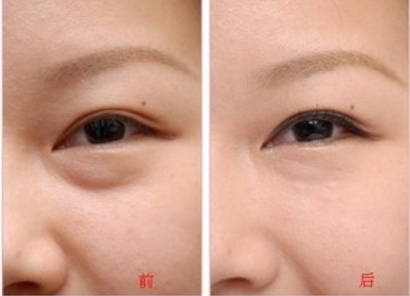 北京长虹医院整形科做激光祛眼袋多久能见效 效果好吗