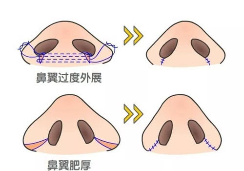 鼻翼厚怎么整形啊 北京幸福整形医院做鼻翼缩小多少钱