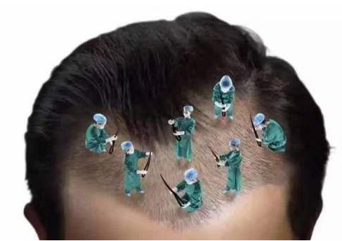 重庆东方毛发医疗整形医院植发大概多少钱 植发能维持多久