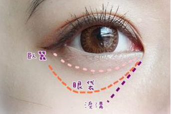 淮北人民医院整形科<font color=red>眼袋是怎么形成的</font> 激光去眼袋的优势