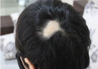 郑州碧莲盛植发整形医院疤痕植发的成功率高不高 