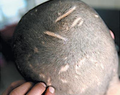 福州海峡植发医院做疤痕植发多少钱 效果怎么样