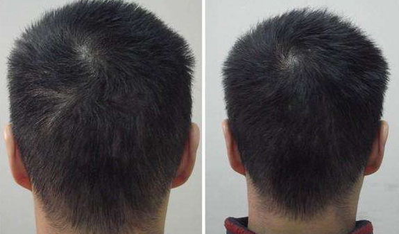 深圳科发源植发整形医院疤痕植发的特点 疤痕种植过程