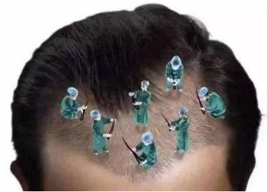 温州伊美尔瑞丽诗植发整形医院种植头发有风险吗 