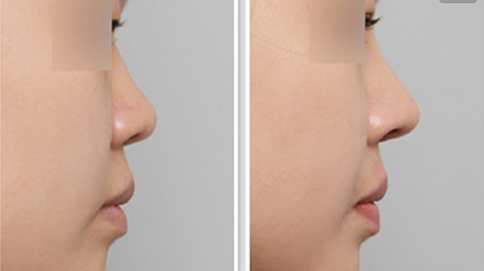 自体软骨隆鼻前后对比图 天津标缇整形自体软骨隆鼻的优势