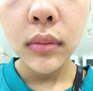 北京丹熙整形医院M唇手术打造甜美微笑唇 很有辨识度