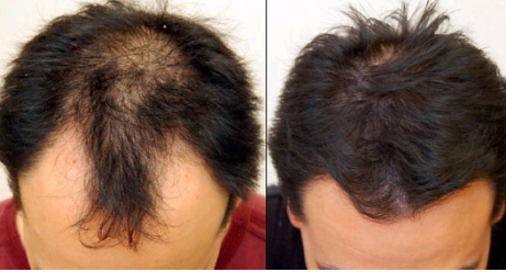 上海美莱毛发移植医院种植头发效果明显吗 适合哪些人呢