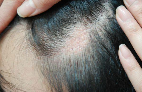 深圳青逸植发整形医院疤痕植发流程 价格是多少 美出新高度