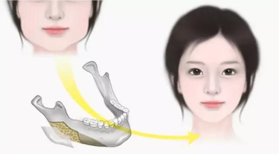 上海安质整形医院各种脸型的V脸下颌角整形方法 你属于哪种