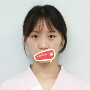 深圳天一国际整形医院假体隆鼻前后对比照 术后颜值爆表