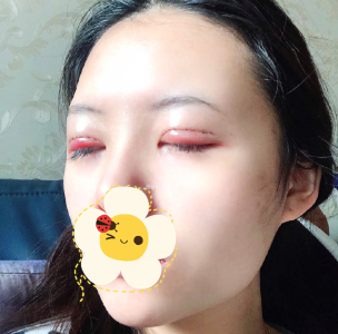 北京美之星整形医院双眼皮修复后拯救了我 瞬间变女神