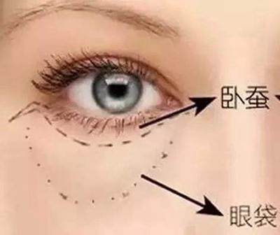 祛眼袋的方法有哪些 郑州百荟美容整形医院 精细无痕祛眼袋