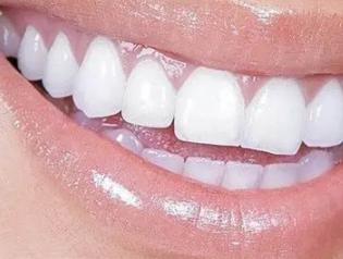 上海松丰齿科门诊部<font color=red>牙齿矫正的优势</font> 牙好更健康