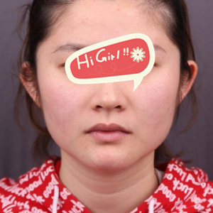 杭州静港整形医院下颌角磨骨恢复过程图 再也不是路人脸了