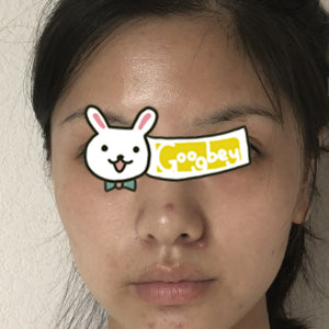 广州凯美达整形医院光子嫩肤术前后对比图 皮肤很有光泽哦