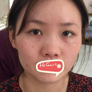 重庆东方整形医院<font color=red>鼻综合</font>个人经历分享 颜值提升一大截